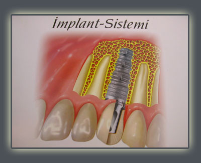 Implant Tedavisi Diþ Hekimi Korhan Korkmaz